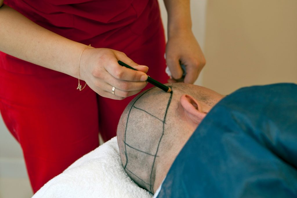 best hair transplant clinic in turkey